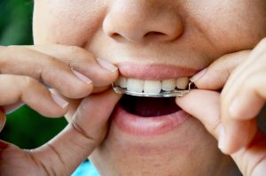 patient putting in a retainer