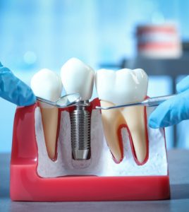 dental implants at our North Miami Beach dental clinic