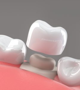 dental crowns at our North Miami Beach dental clinic