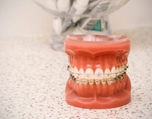 model of braces on teeth
